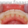 Kép 2/2 - Fiber Splint Ortho evo